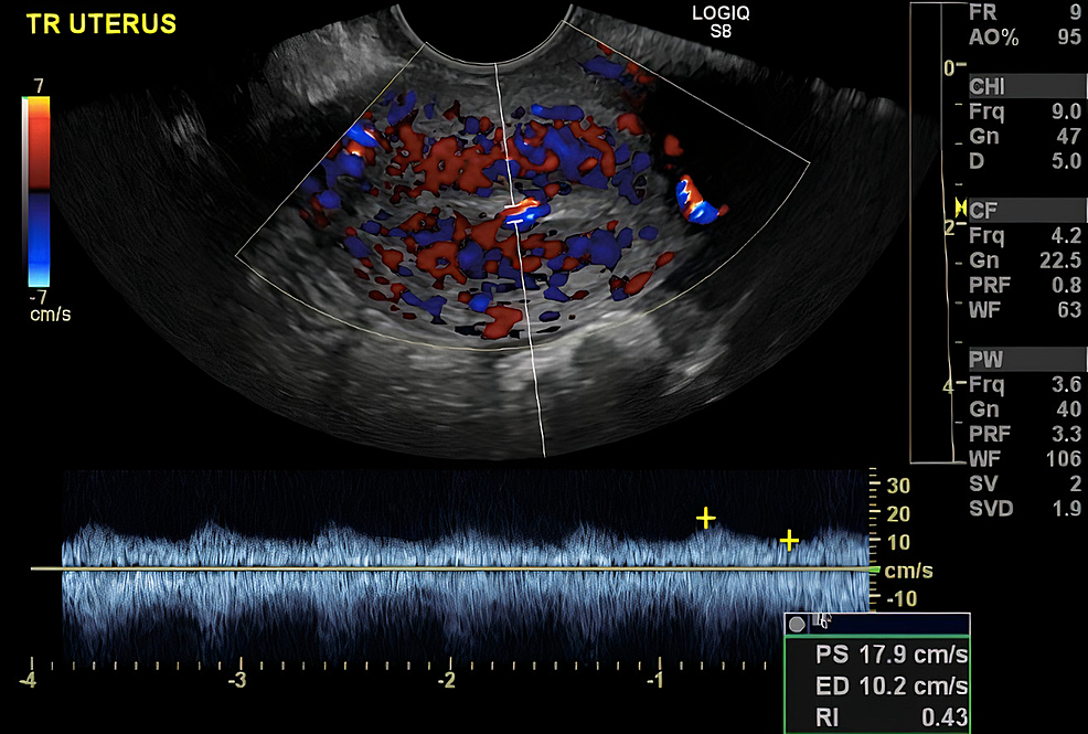 Cureus | Fertility-Preserving Management of Uterine Arteriovenous ...