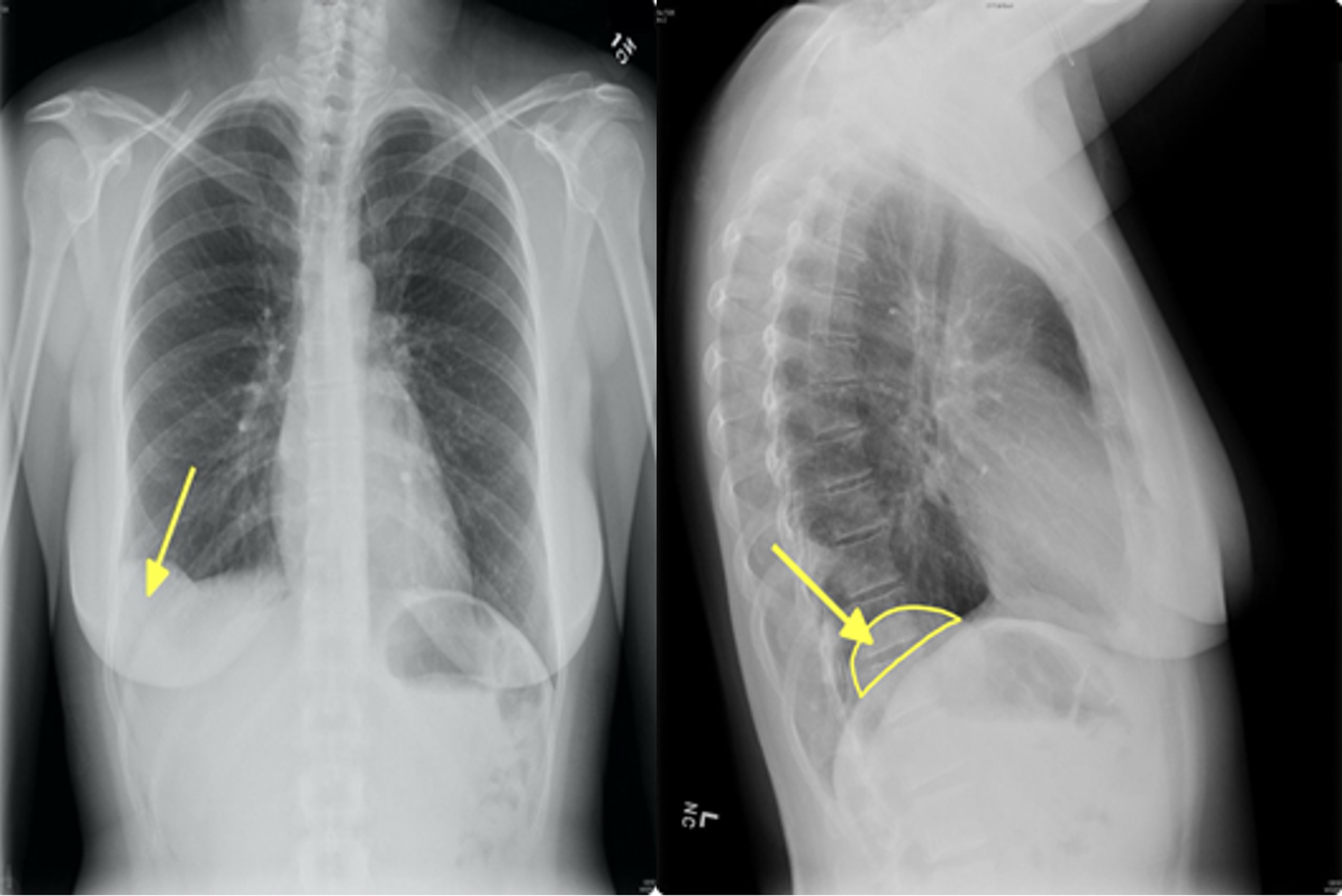 Cureus | Symptomatic Pulmonary Hamartoma