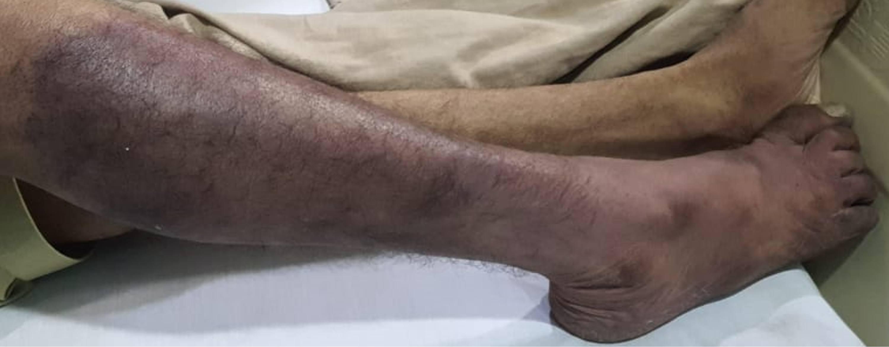 Acute Limb Ischemia Causes Up To Date