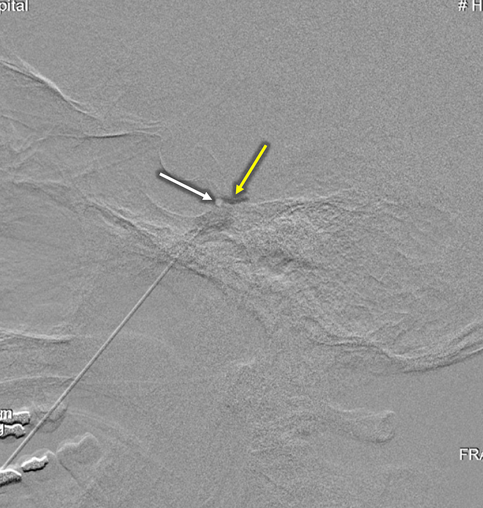 Cone Beam Ct With Flat Panel Detector And Biplane Fluoroscopy Guided Percutaneous Trigeminal