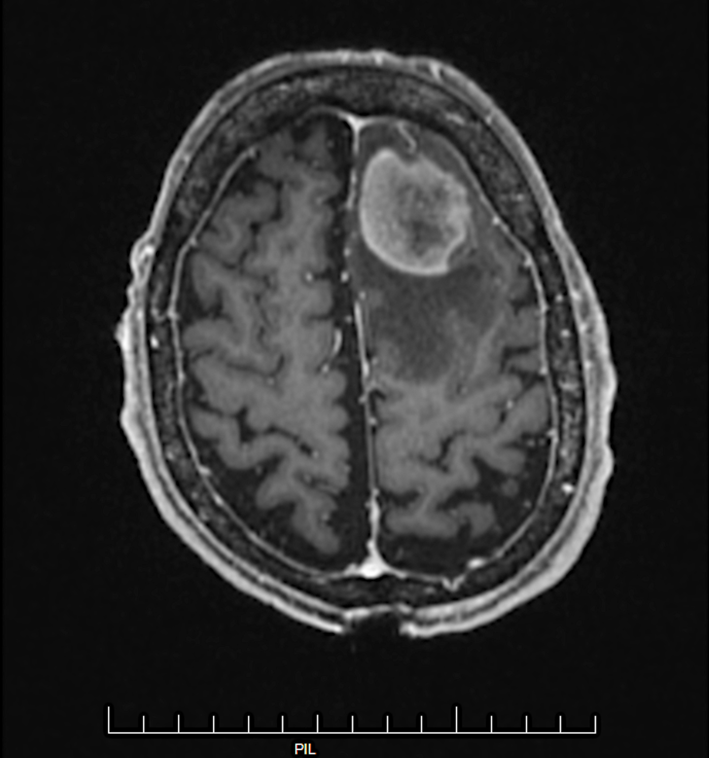 Cureus | Primary Central Nervous System Lymphoma With Systemic Recurrence