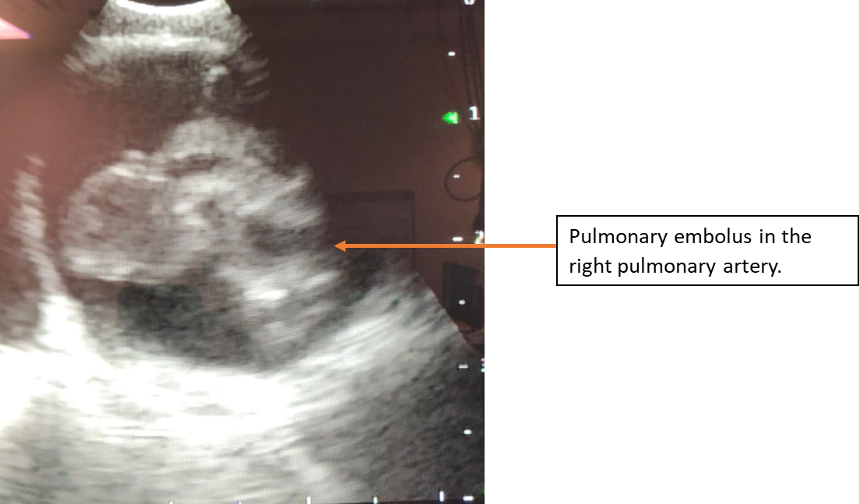 Cureus Utility of Bronchoscopy With Endobronchial Ultrasound in