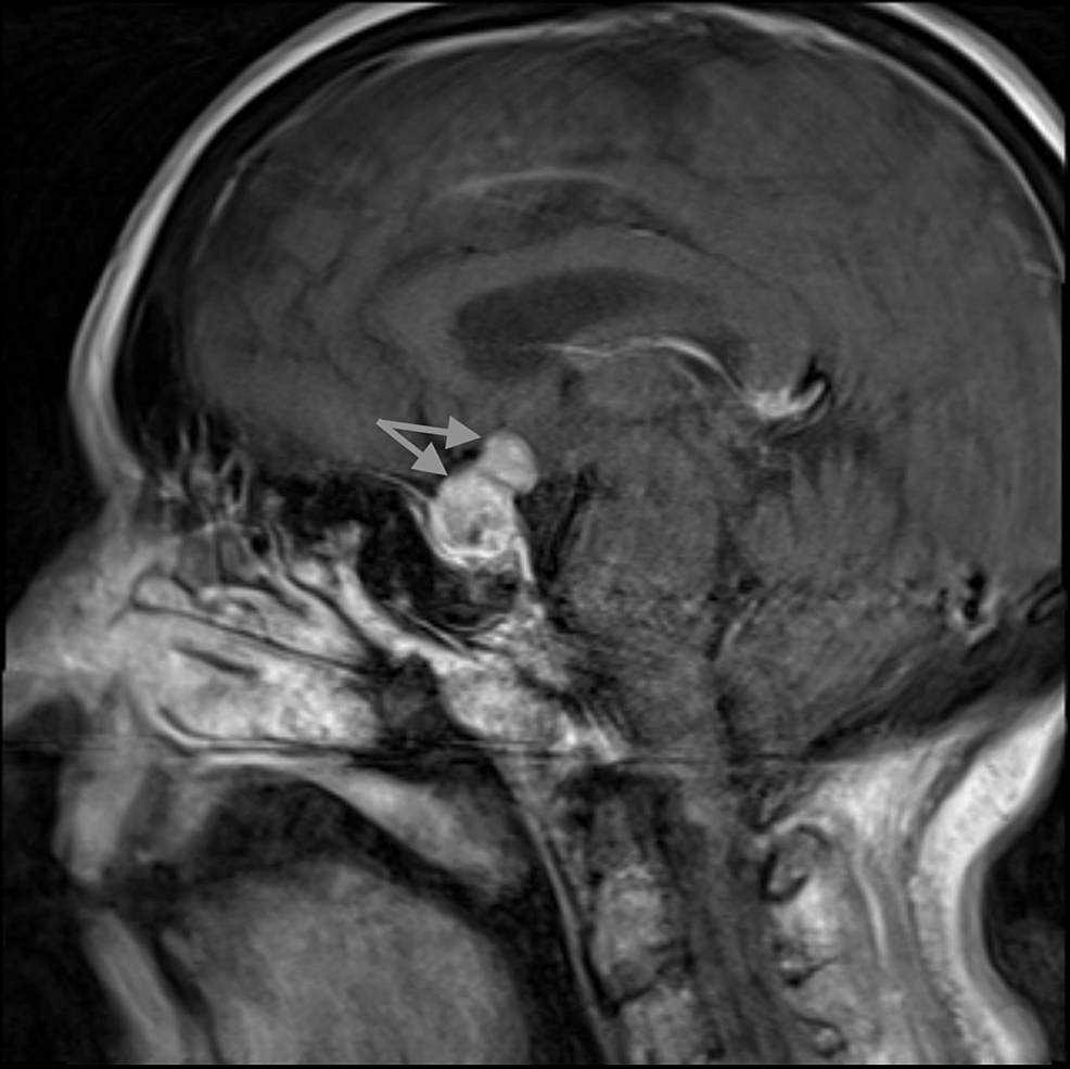 T1-post-contrast-brain-MRI-with-pituitary-protocol-(sagittal-image)