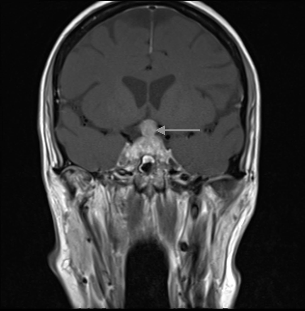 T1-post-contrast-brain-MRI-with-pituitary-protocol-(coronal-image)