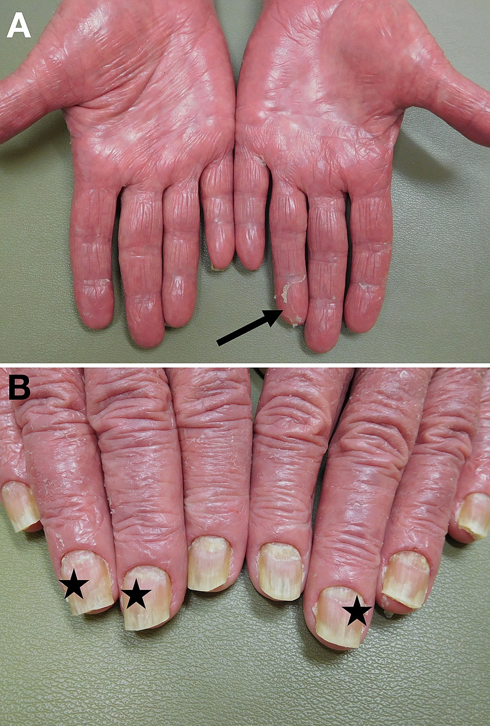 Cureus | Erythrodermic Psoriasis In A Man With Monoclonal B-cell ...