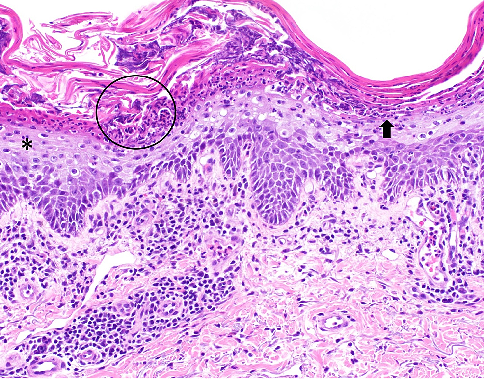 Cureus | Erythrodermic Psoriasis In A Man With Monoclonal B-cell ...