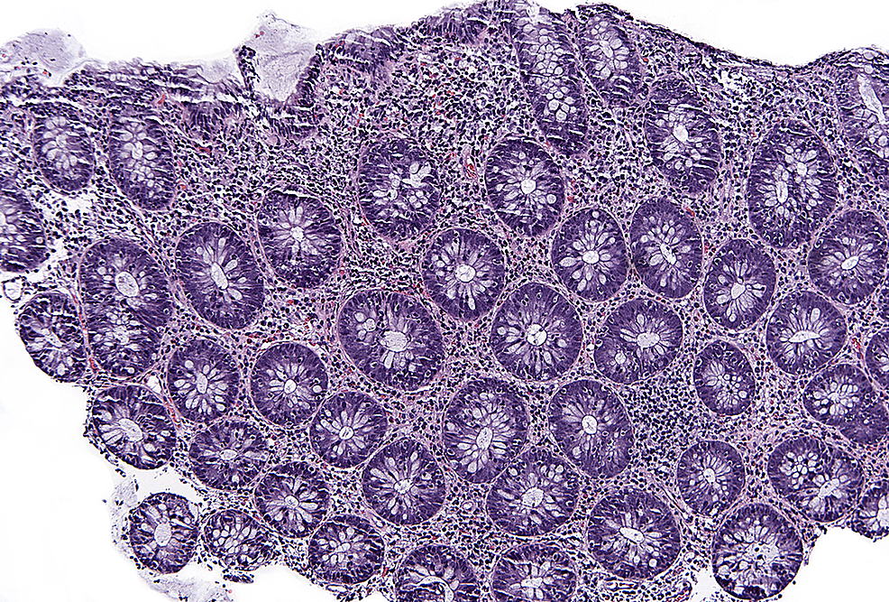 cureus-immune-checkpoint-inhibitor-induced-colitis-presenting-as