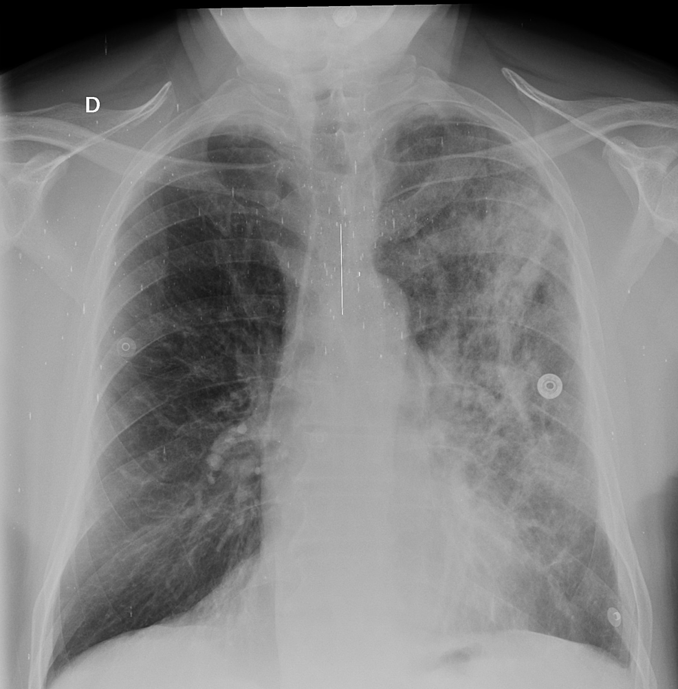Chest-X-ray-showing-the-regression-of-the-alveolo-interstitial-syndrome-in-the-left-lung-one-week-after-the-treatment