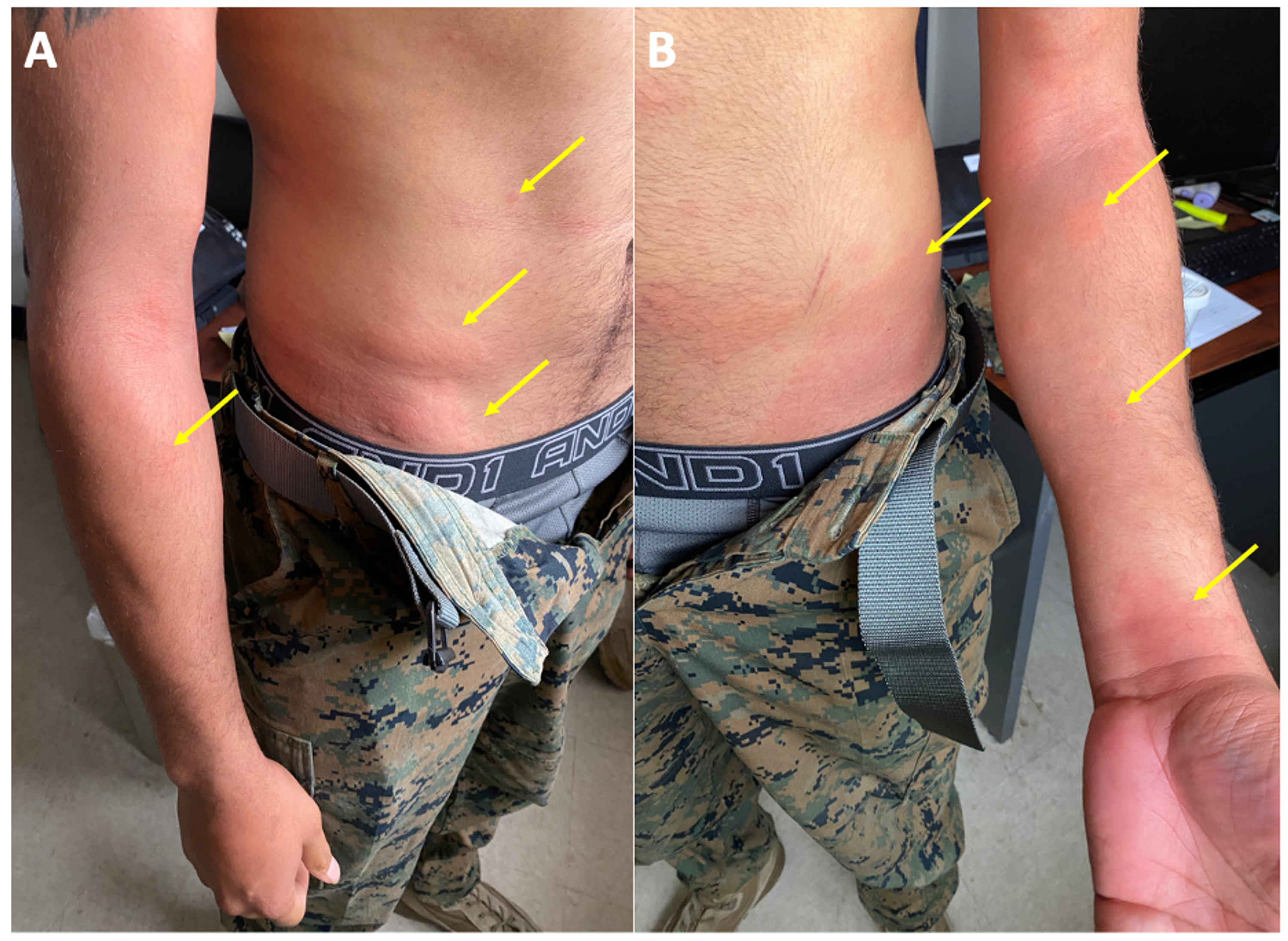 bupropion rash