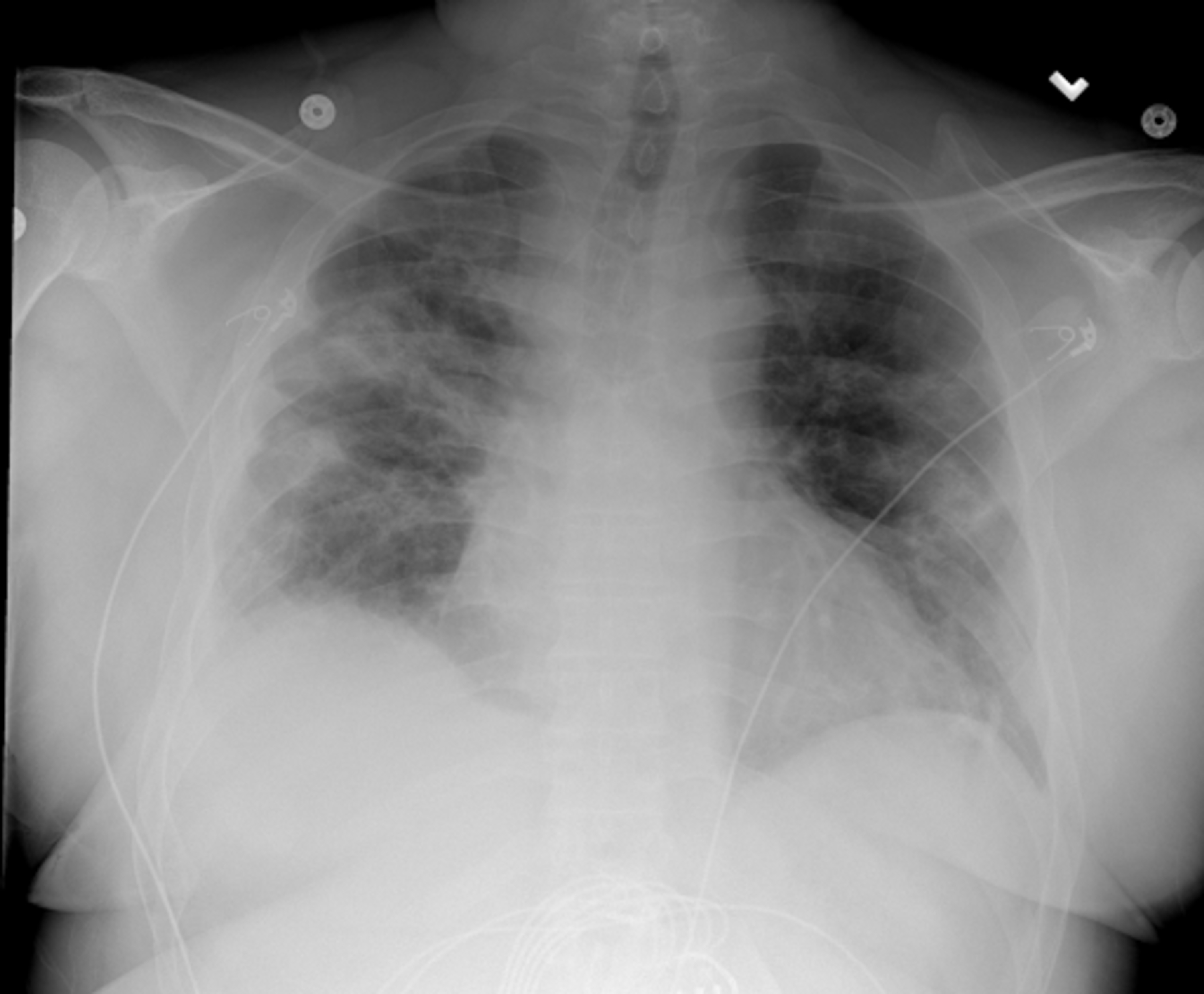 Cureus | Unusual Presentation of a Rare Pneumothorax in a Patient With ...