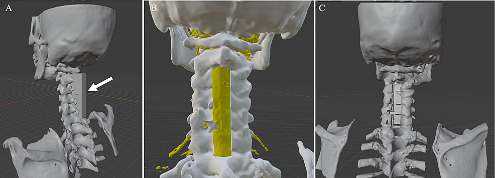 The-creation-of-a-laminectomy-model-using-the-3D-image-editing-software-Blender