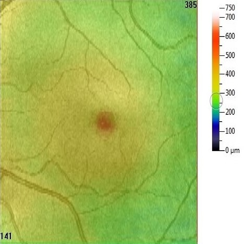 Cureus LaserInduced Maculopathy and After Treatment With