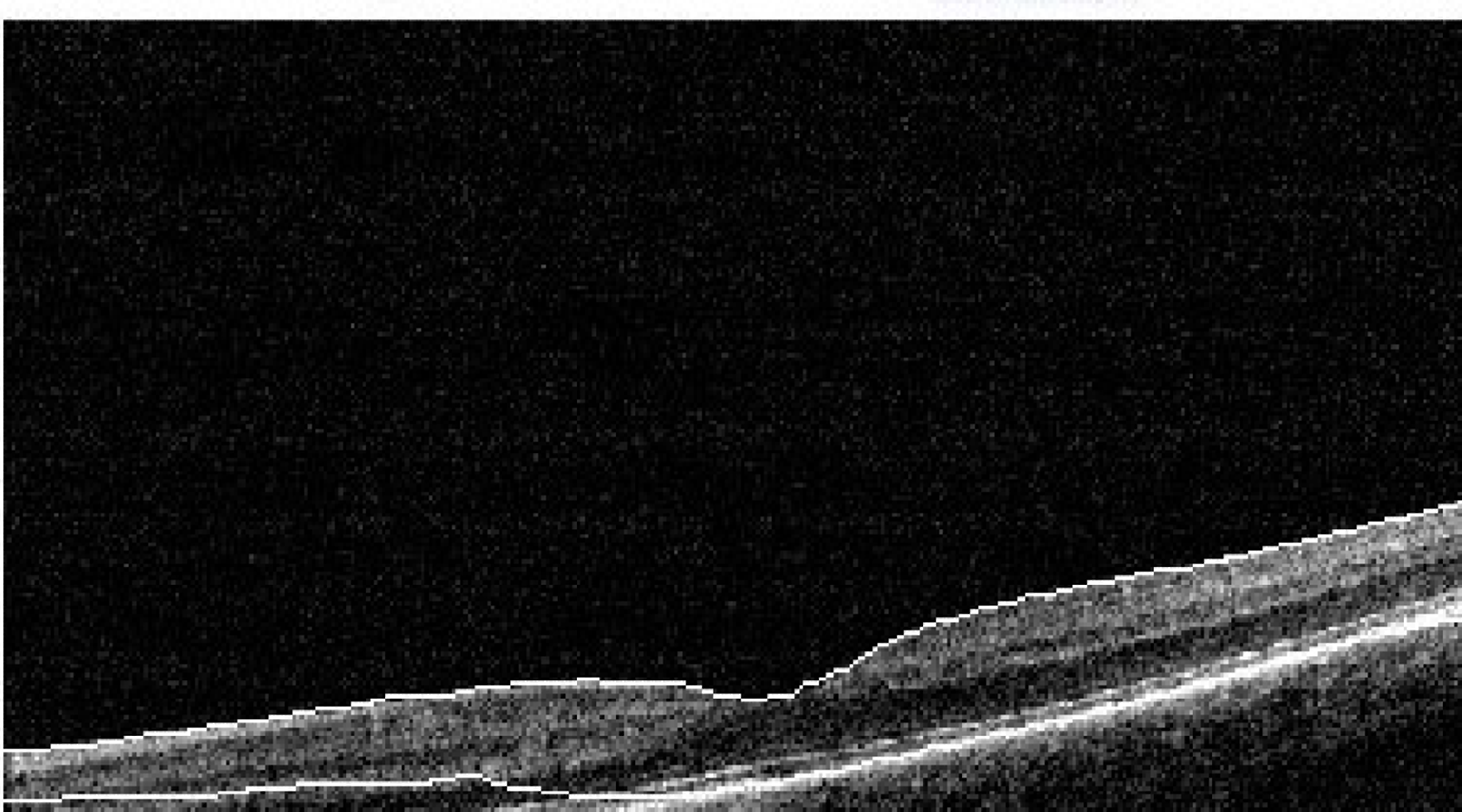 Cureus LaserInduced Maculopathy and After Treatment With