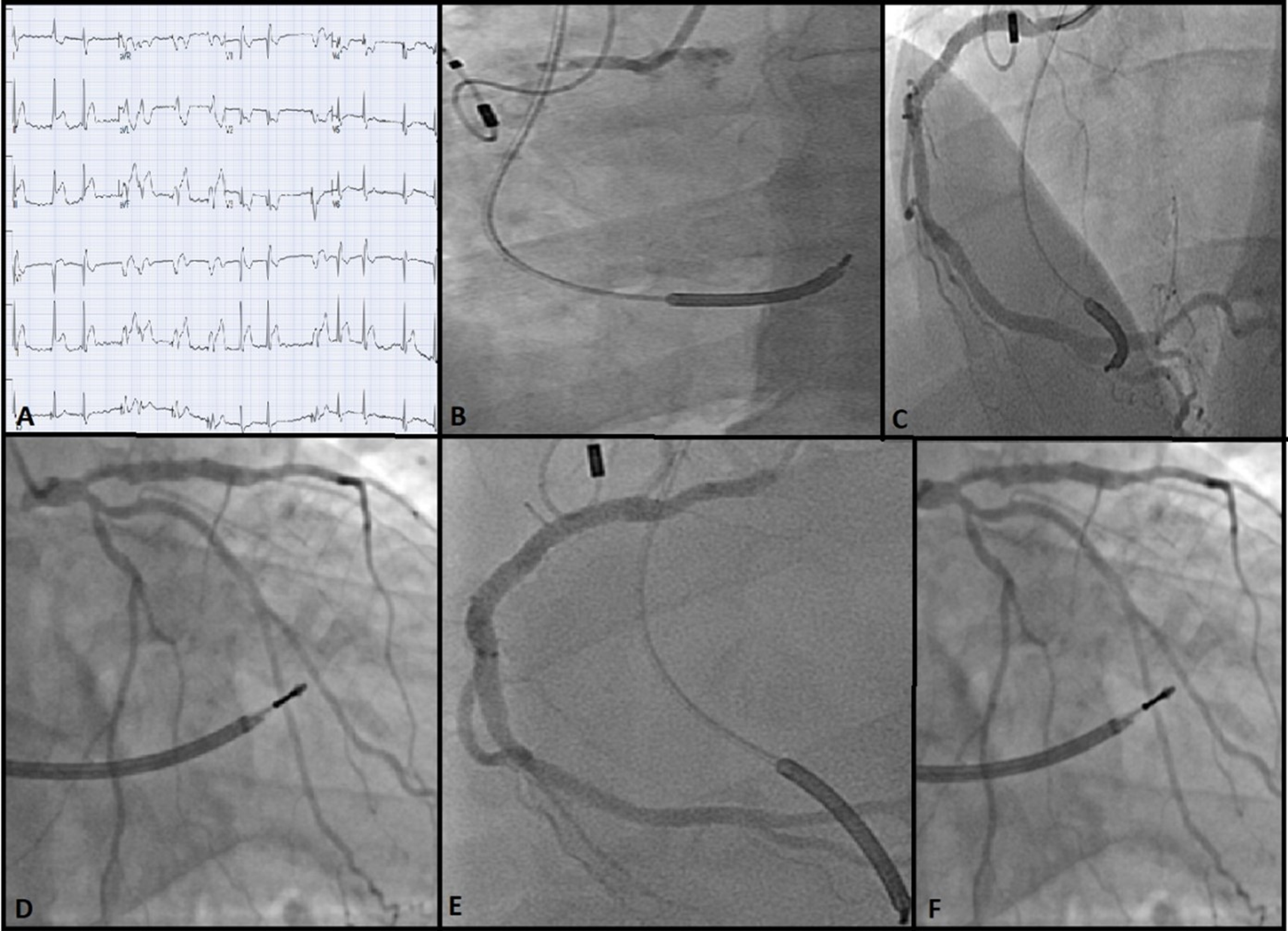 Management Of Stent Thrombosis Post-Percutaneous Coronary Intervention ...