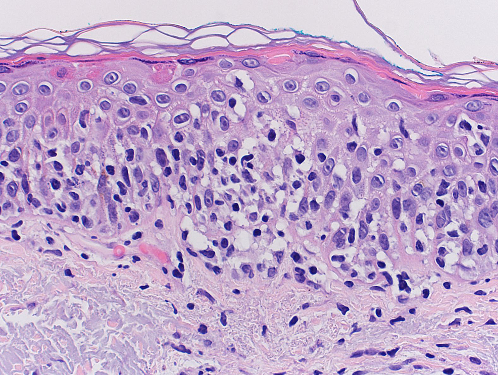 Cureus | Pagetoid Reticulosis: A Rare Dermatologic Malignancy ...