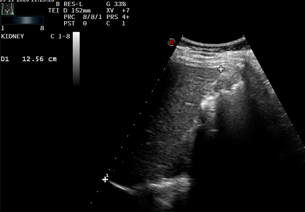 Gallstone with wall-echo-shadow sign. Ultrasound shows a typical