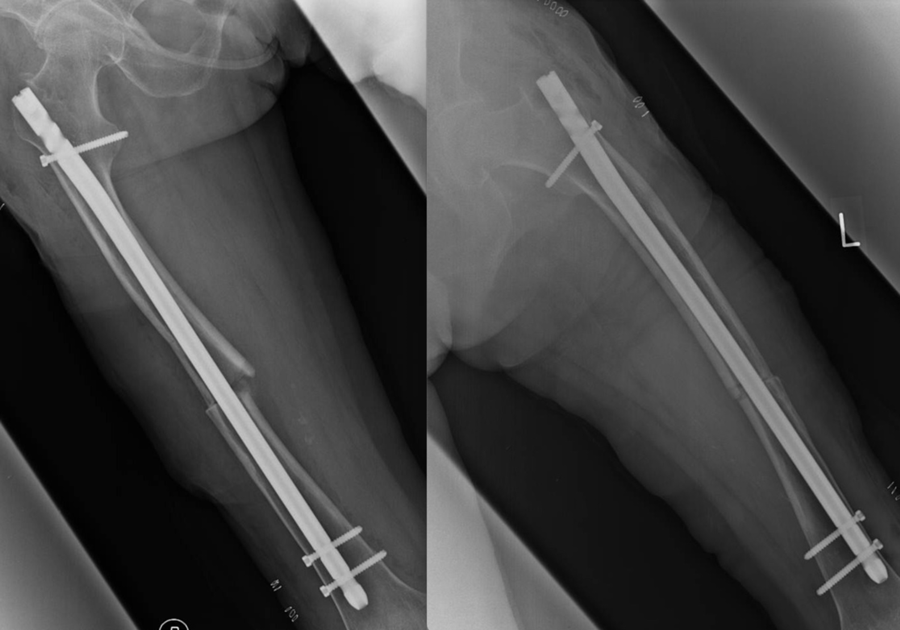 Cureus Open Reduction and Internal Fixation of Simultaneous