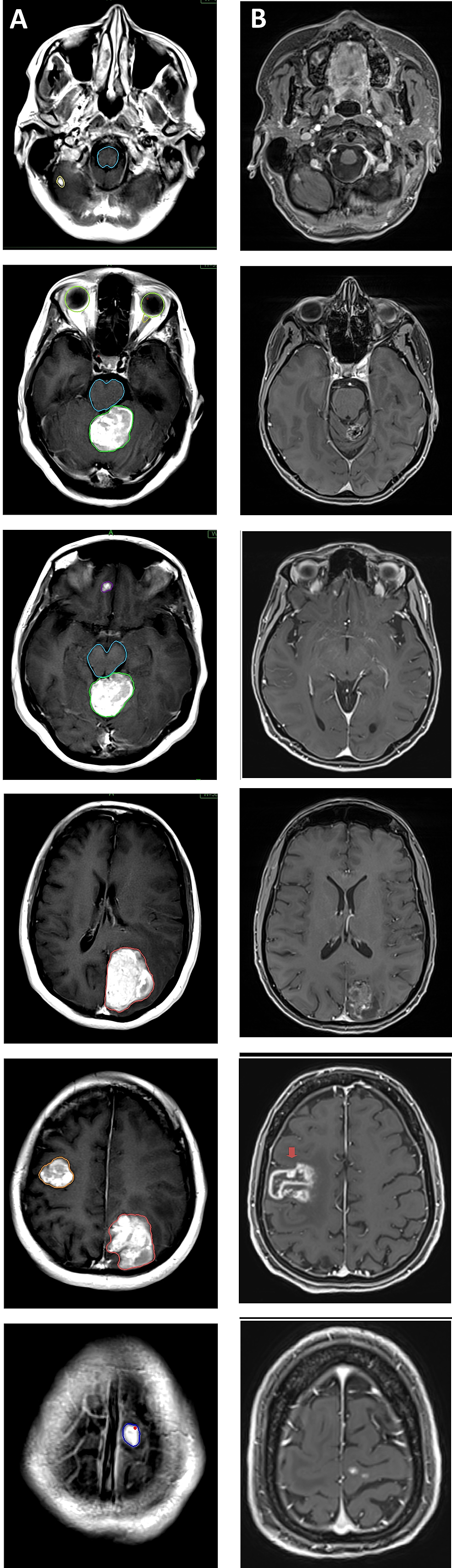 Cureus Nonsmall Cell Lung Cancer with Multiple Brain Metastases