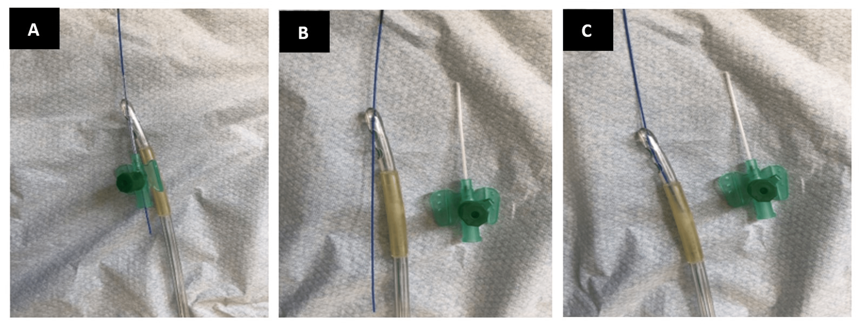 Cureus An Easy Solution for Difficult Urethral Catheter ThreeWay