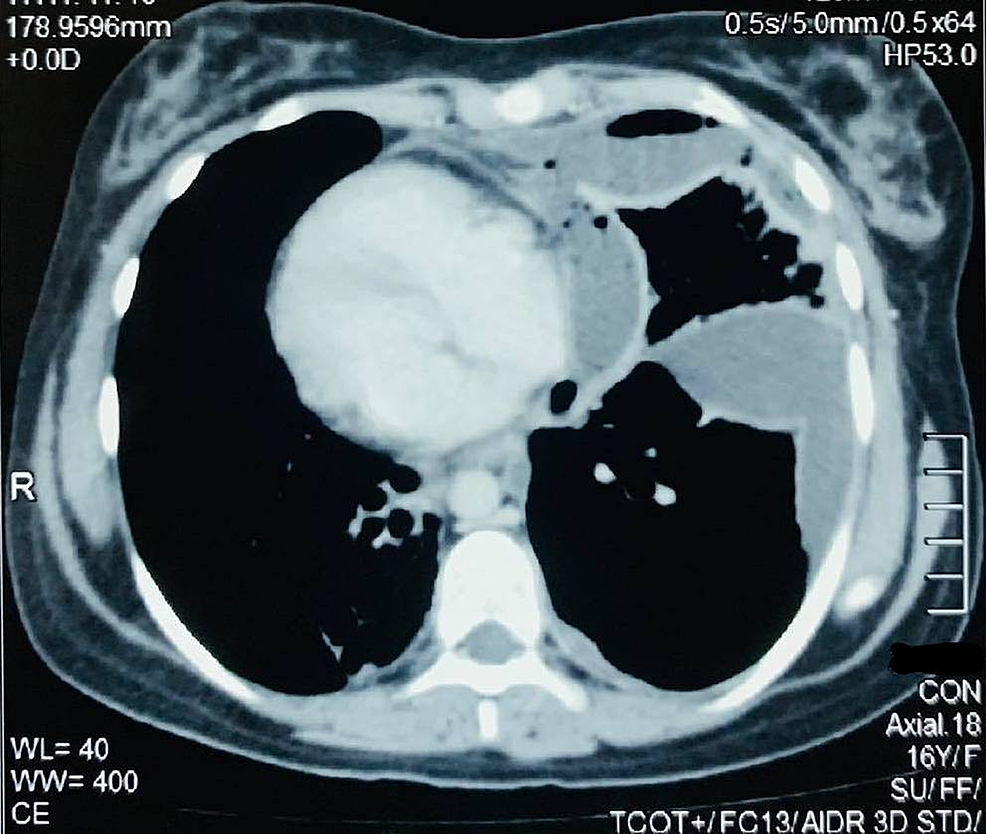 Cureus VideoAssisted Thoracoscopic Decortication of Left Lung