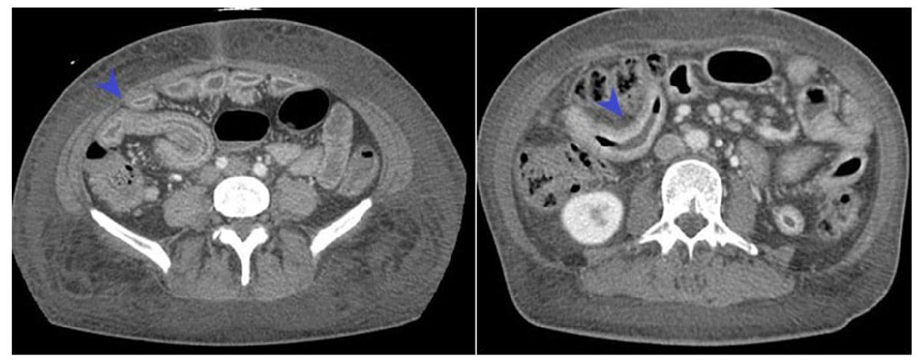 Cureus ProteinLosing Enteropathy in Crohn's Disease Two Unusual Cases