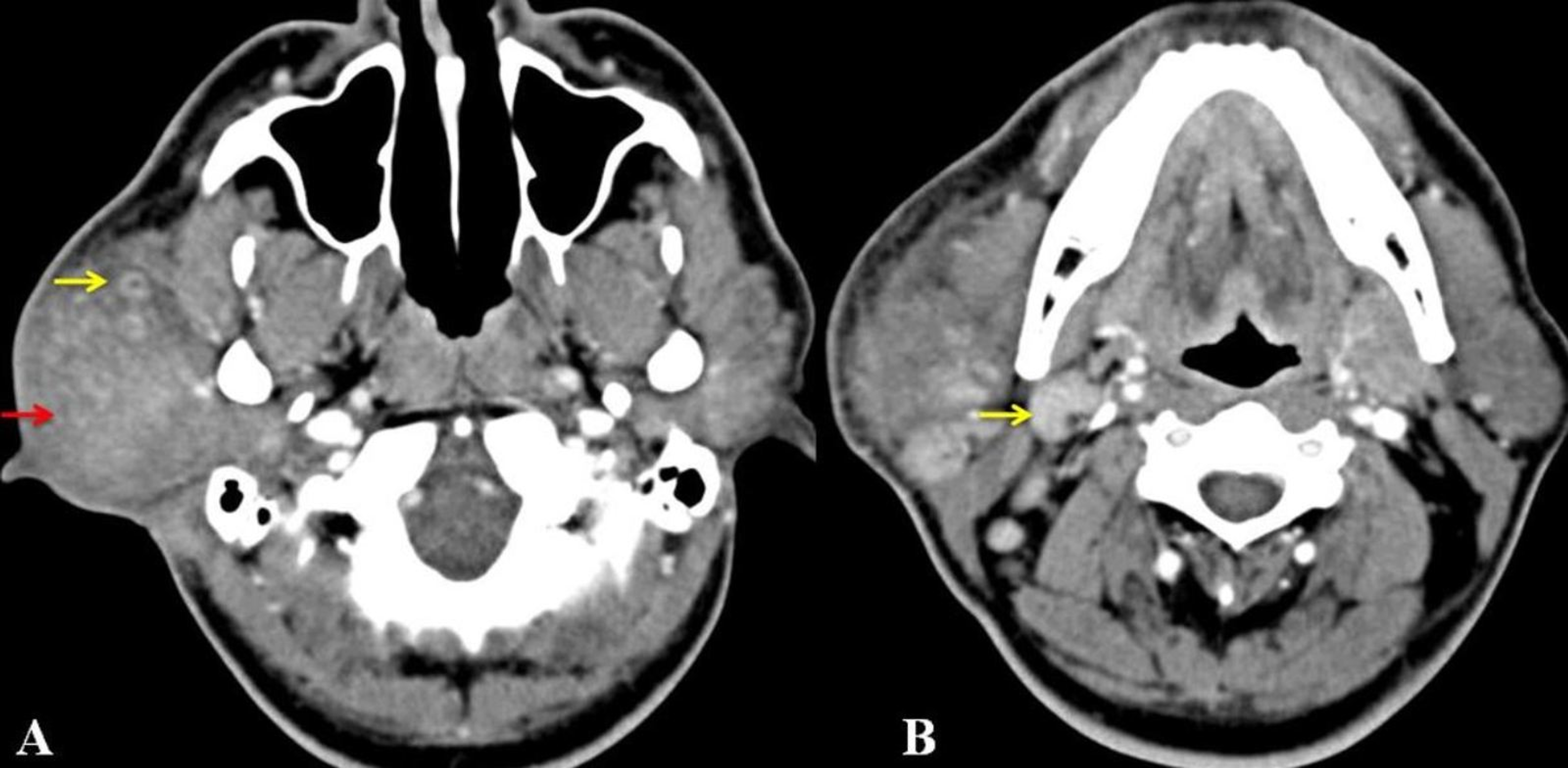 Cureus Kimura Disease Presenting As Right Parotid Swelling And Neck