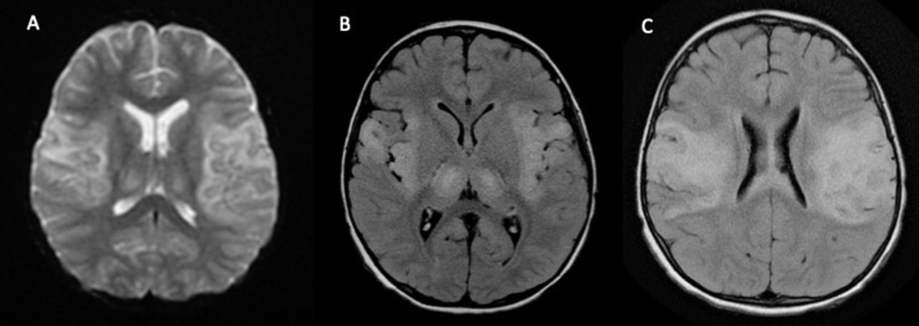 Cureus | Atypical Brain MRI Findings in a Child With Delayed Diagnosis ...