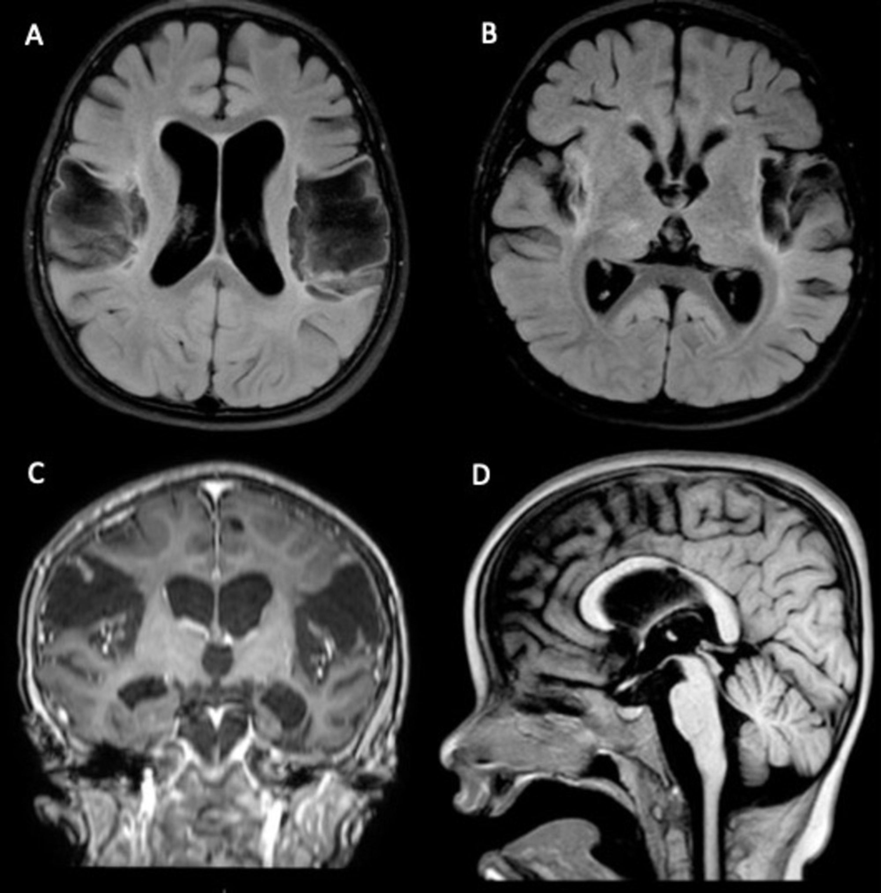 Cureus | Atypical Brain MRI Findings in a Child With Delayed Diagnosis ...