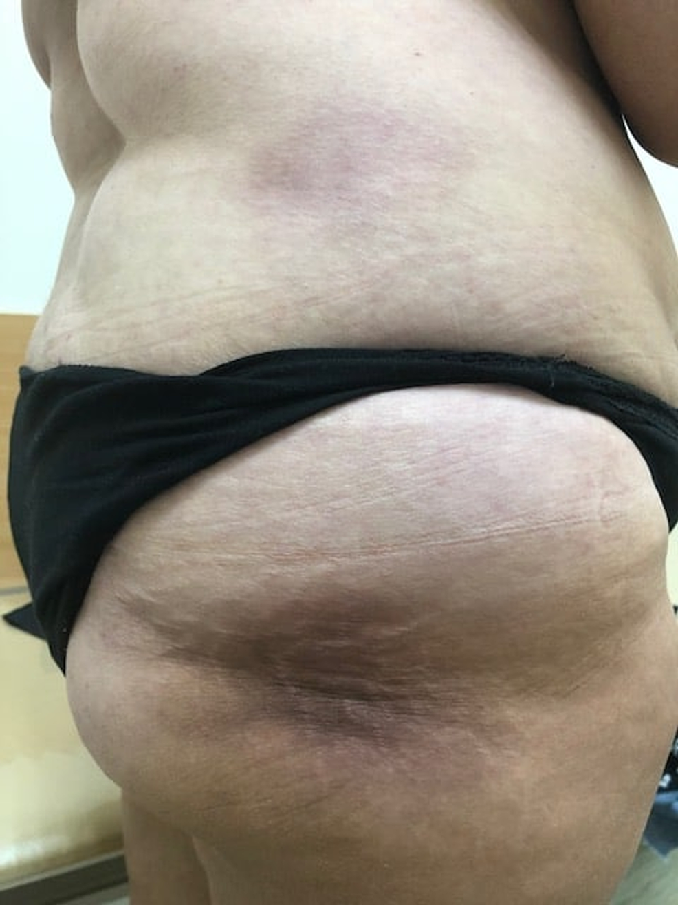 Patient’s-skin-changes:-a-rounded-purple-cyanotic-painless-dense-formation-is-seen-on-the-right-lateral-surface-of-the-trunk-and-buttock.