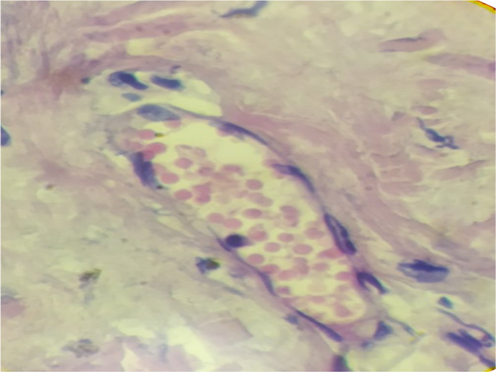 Biopsy-of-the-skin-showing-light-microscopy-appearance-of-erythrocytes-and-mononuclear-cells-in-the-vascular-lumens-(hematoxylin-eosin-staining,-100×,-200×).