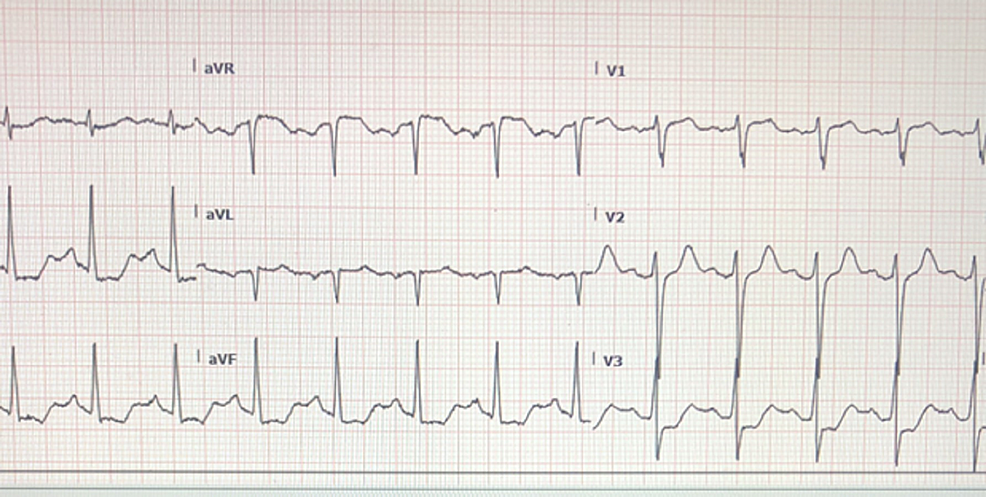 Initial-EKG-performed-showing-sinus-tachycardia-at-130-bpm-with-ST-segment-depression-in-the-infero-lateral-lead.
