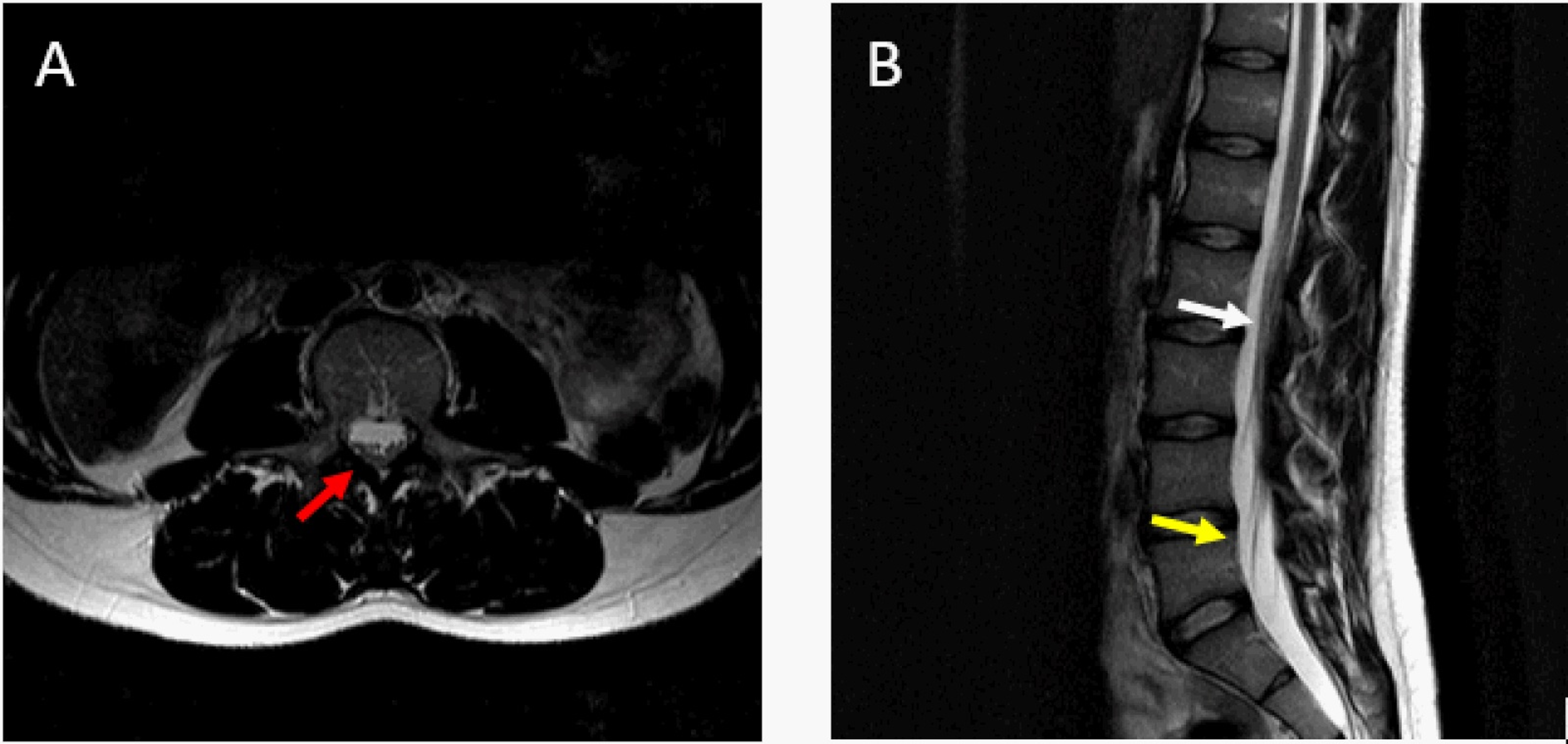 Cureus Complicated Neuraxial Anesthesia in a Patient With Tethered