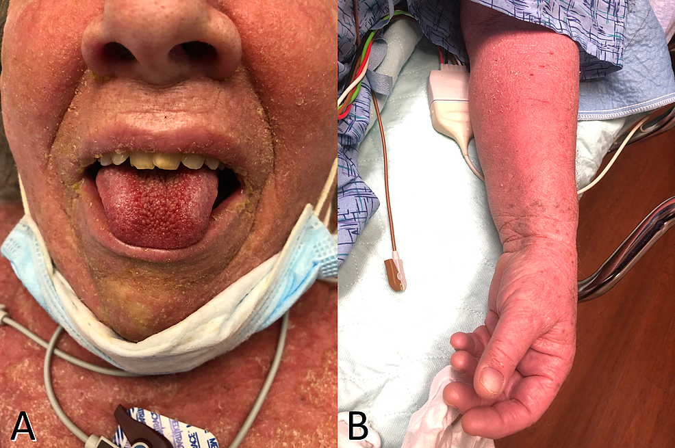 Cureus Erythrodermic Psoriasis Exacerbated by Bupropion Article