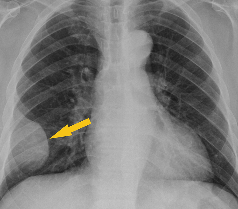 Chest-X-ray-shows-a-low-density-soft-tissue-structure-located-at-the-periphery-of-the-right-hemithorax,-measuring-approximately-9-cm-in-size