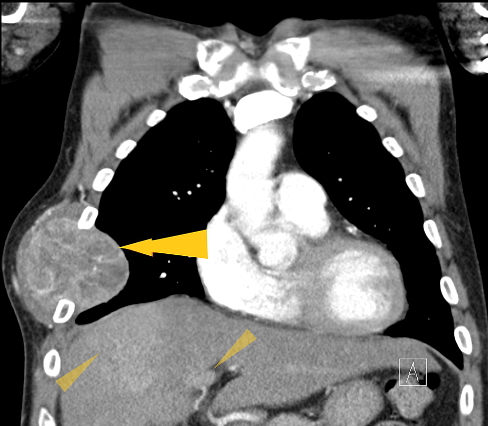 Computed-tomography-of-the-chest,-with-contrast,-shows-a-heterogeneously-enhanced-soft-tissue-mass-arising-from-the-right-anterolateral-sixth-rib-(yellow-arrow),-which-was-eroded-and-replaced-by-a-portion-of-the-mass-that-appeared-extrapleural.-Multiple-ill-defined,-hyper-attenuating-foci-in-the-liver-are-present,-including-a-larger-one-measuring-2×1.2-cm-in-the-right-lobe-and-one-measuring-2.8-cm×1.4-cm-in-the-gastrohepatic-lymph-node-(yellow-triangles).