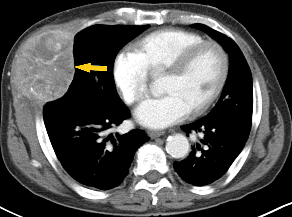 Computed-tomography-of-the-chest,-with-contrast,-shows-a-heterogeneously-enhanced-soft-tissue-mass-arising-from-the-right-anterolateral-sixth-rib-(yellow-arrow),-which-was-eroded-and-replaced-by-a-portion-of-the-mass-that-appeared-extrapleural