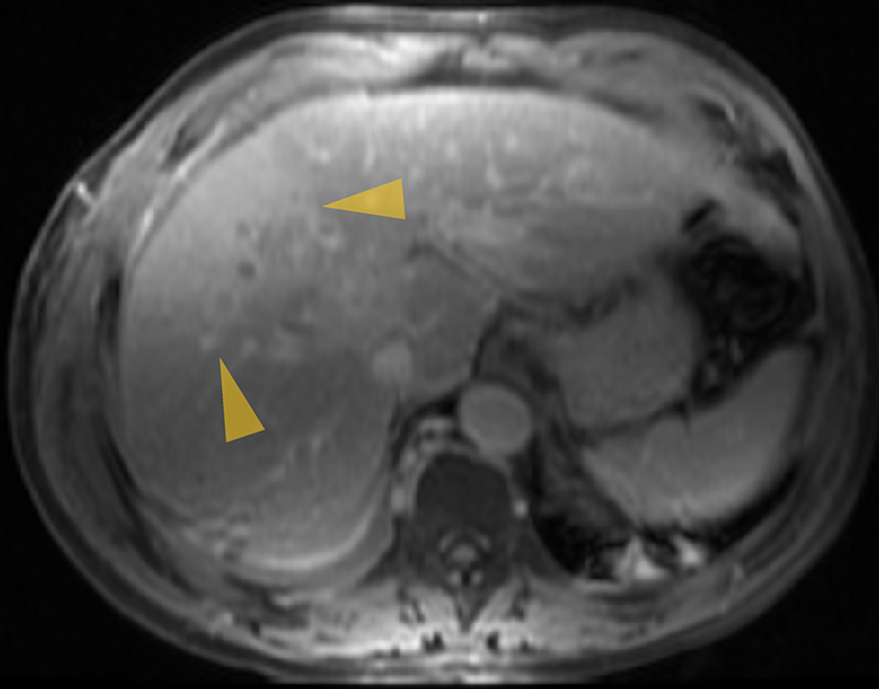 MRI-abdomen-with-contrast-showing-hypervascular-mass-lesions-with-poorly-defined-margins-in-both-the-right-and-left-lobes-of-the-liver.-The-larger-one-measures-7-cm×5-cm-in-the-anterolateral-surface-of-the-right-lobe-and-abutting-the-diaphragmatic-surface.
