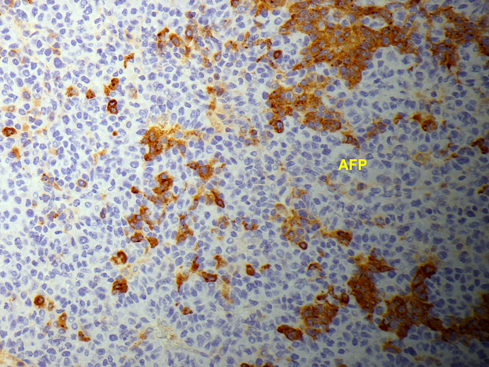 Histopathology-with-immunohistochemical-staining-of-the-biopsy-of-the-chest-wall-mass-shows-malignant-hepatocytes-positive-for-alpha-fetoprotein,-confirming-this-as-a-hepatocellular-carcinoma-metastasis