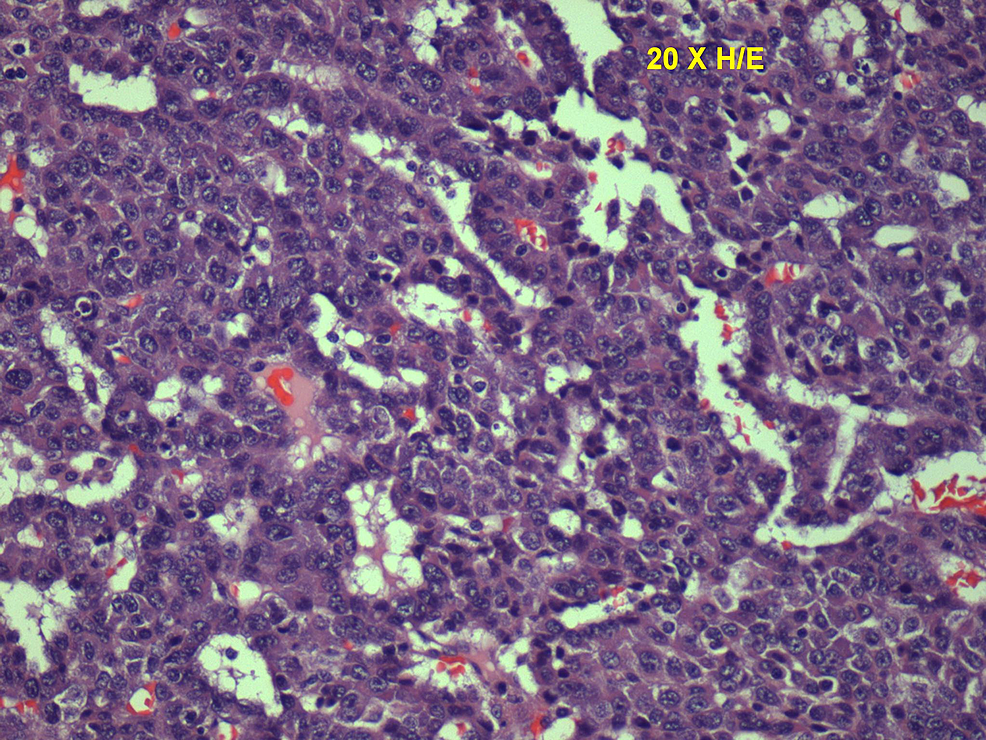 Histopathology-slide-showing-trabecular-and-sheet-like-areas-and-large-malignant-cells-with-high-mitotic-activity-and-areas-of-necrosis