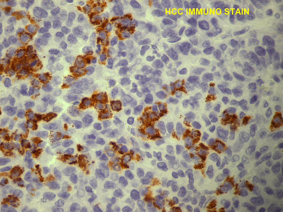 Histopathology-with-immunohistochemical-staining-of-the-biopsy-of-the-chest-wall-mass-shows-malignant-hepatocytes-positive-for-HCC-immunostain,-confirming-this-as-a-hepatocellular-carcinoma-metastasis