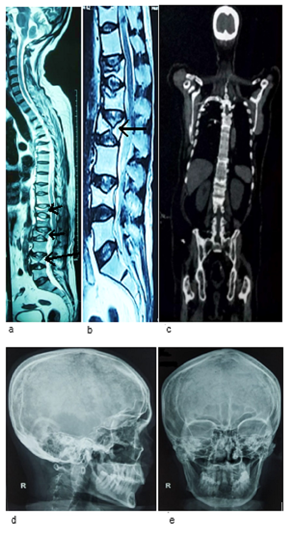 MRI of the dorso-lumbar spine showing a partial collapse of the D12