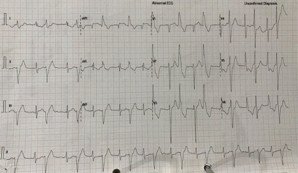 Successful Percutaneous Coronary Intervention in a Patient With aVR ST ...