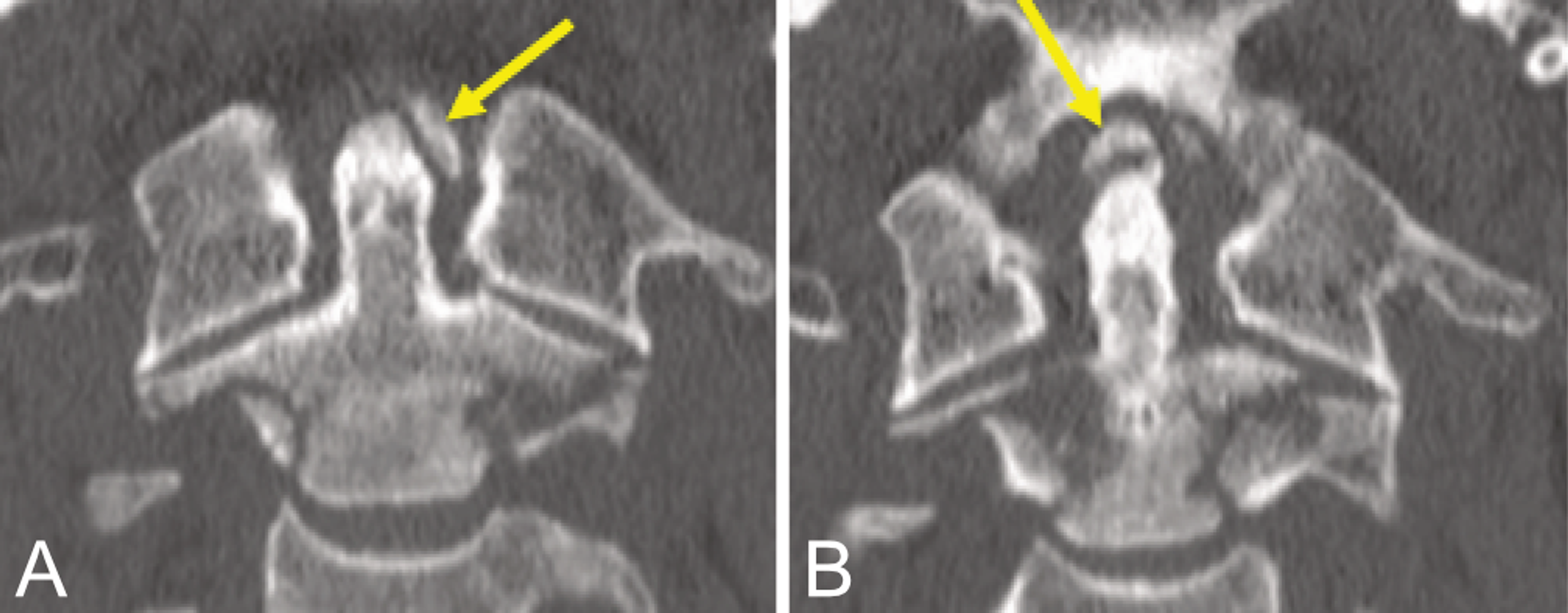 Cureus Vertical Fracture Of The Odontoid Process 4840