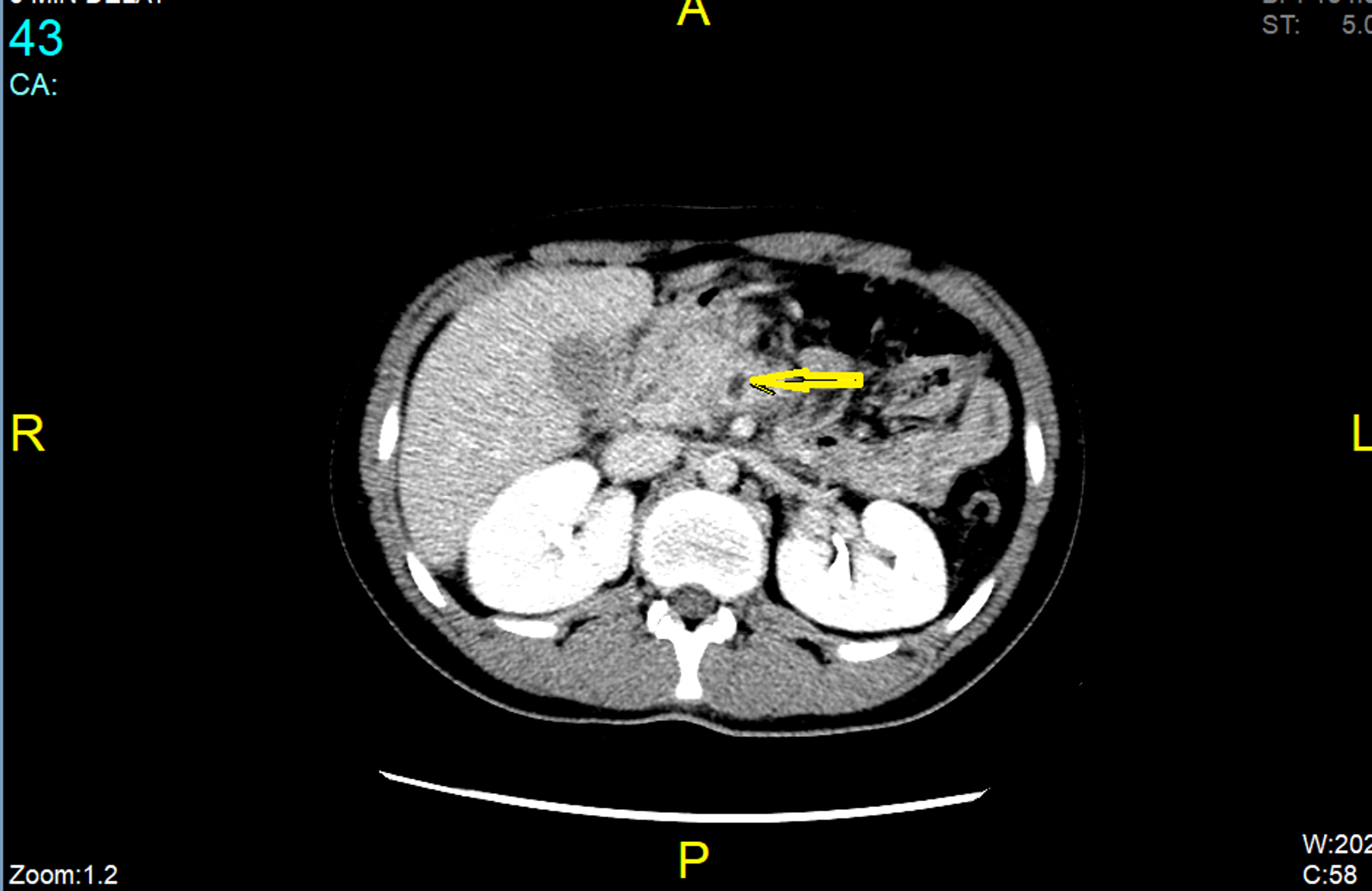 Cureus Recurrent Acute Pancreatitis And Superior Mesenteric Venous Thrombosis Cause Or Course Cureus Recurrent Acute Pancreatitis And Superior Mesenteric Venous Thrombosis Cause Or Course