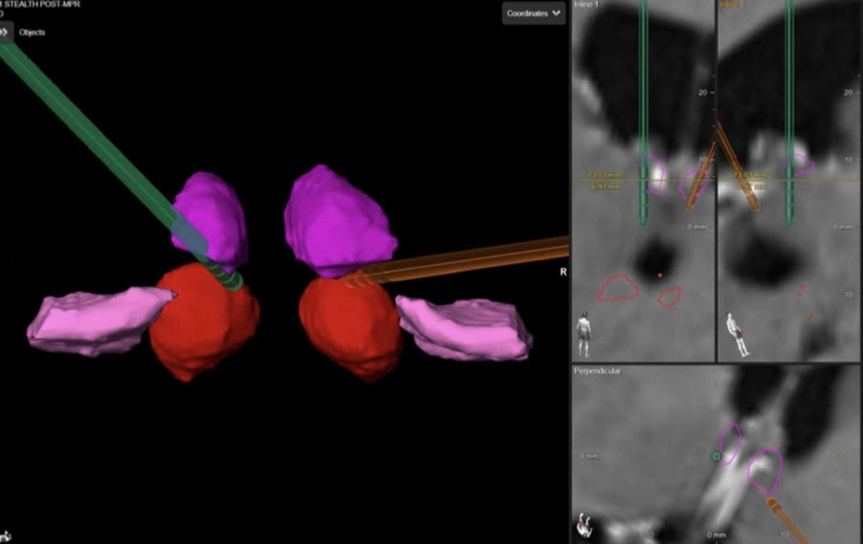 Cureus | Epilepsy and Deep Brain Stimulation of Anterior Thalamic Nucleus