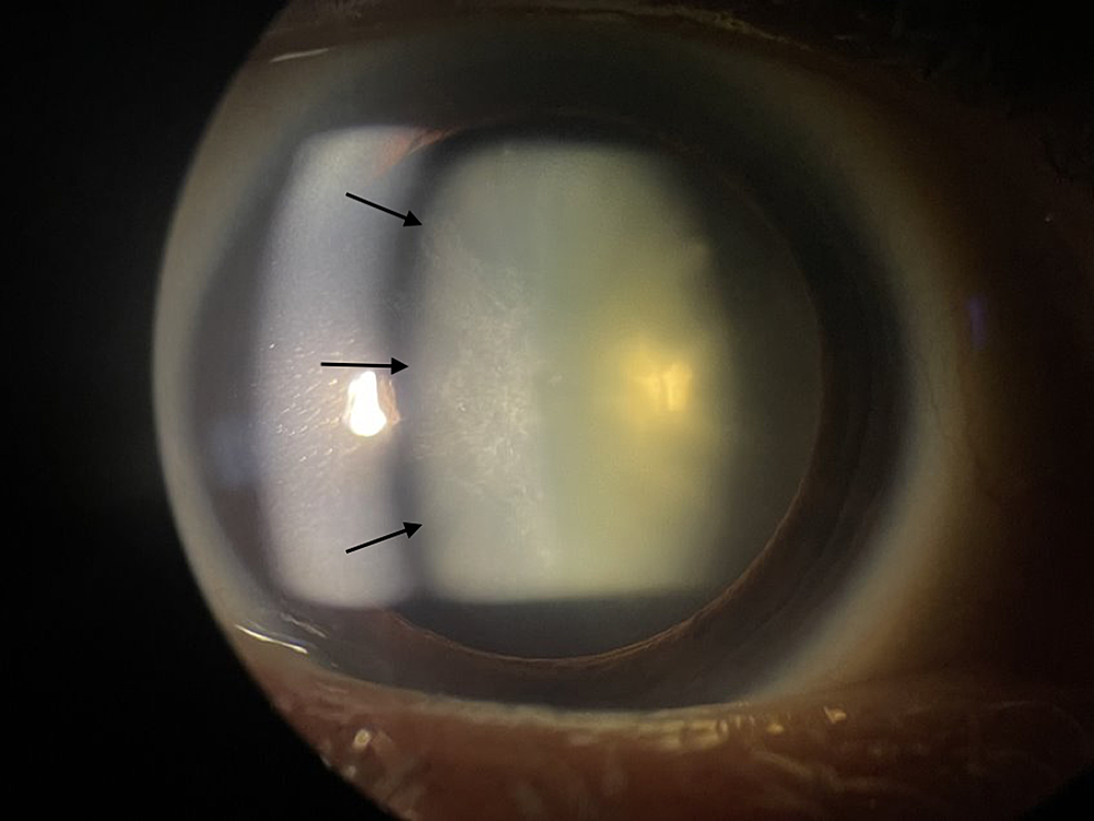 Slit-lamp-image-of-the-patient’s-left-eye-with-a-large-anterior-subcapsular-cataract-(black-arrows).