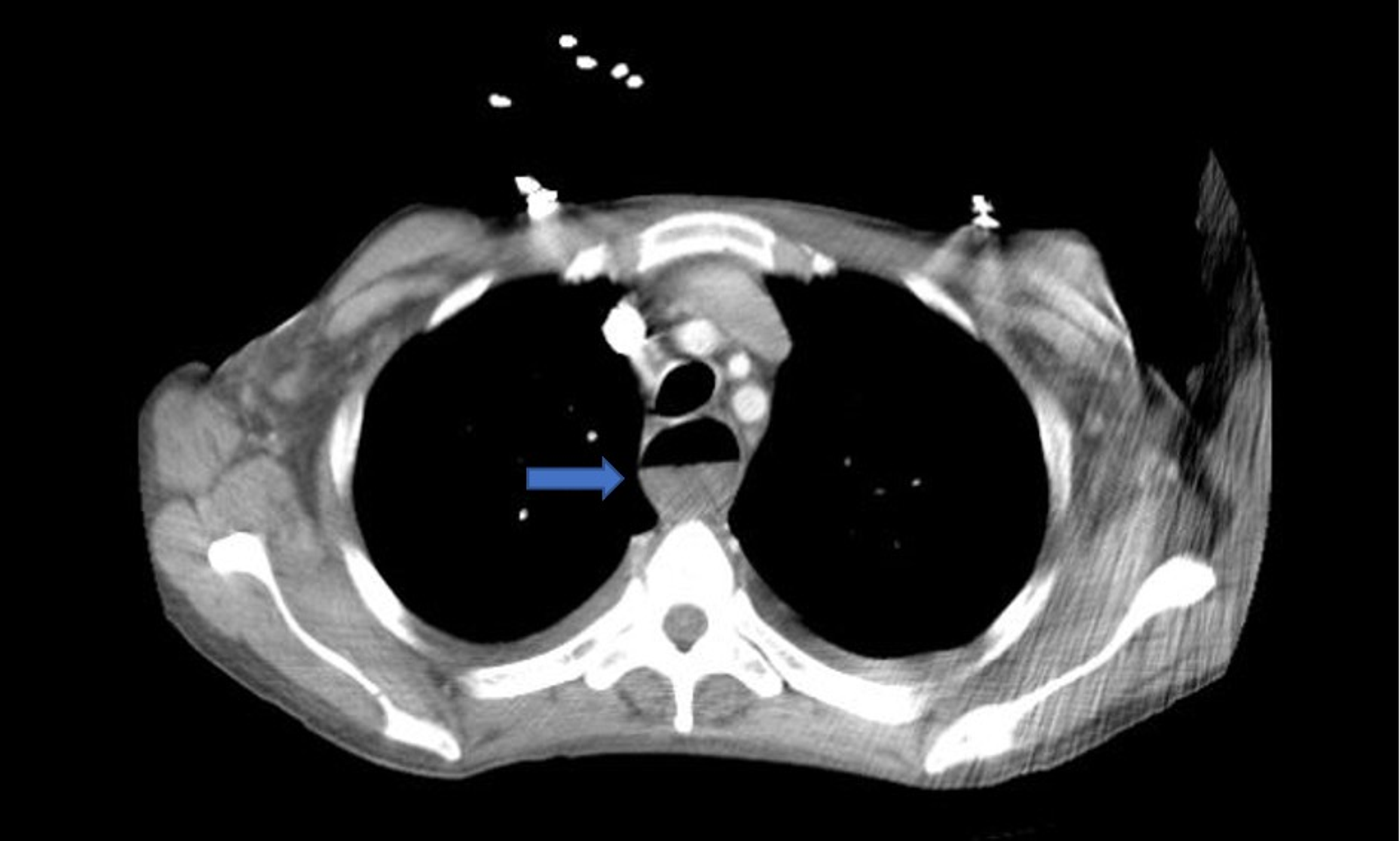 Cureus A Case of Esophageal Plasmablastic Lymphoma With a Literature Review