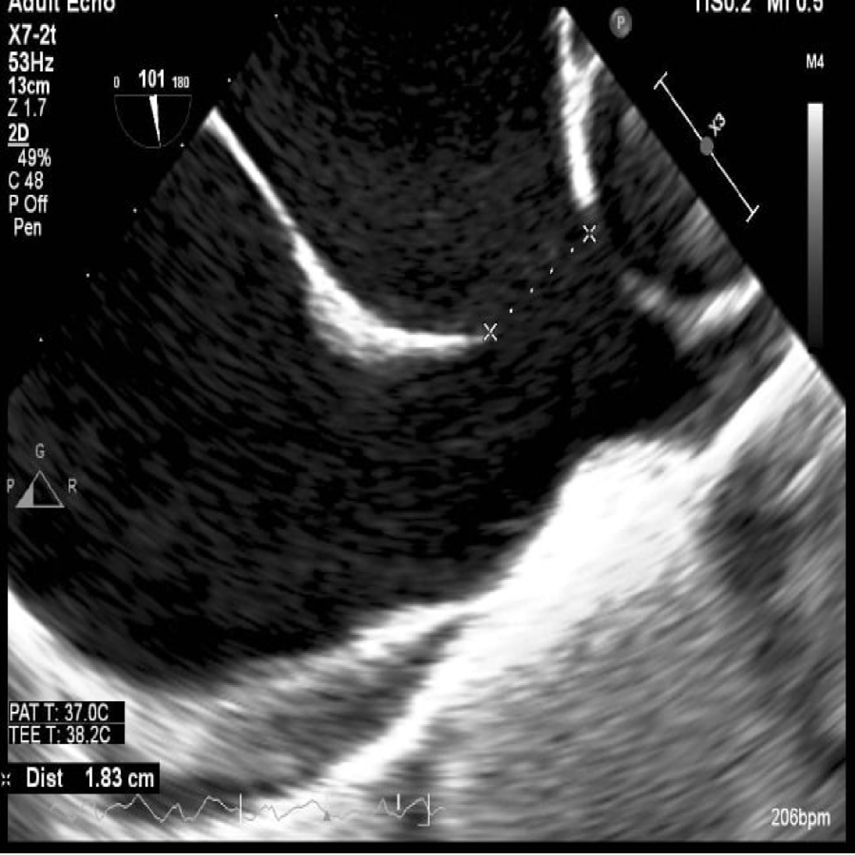 Lipomatous Hypertrophy Of The Atrial Septum Icd Sitelip Org