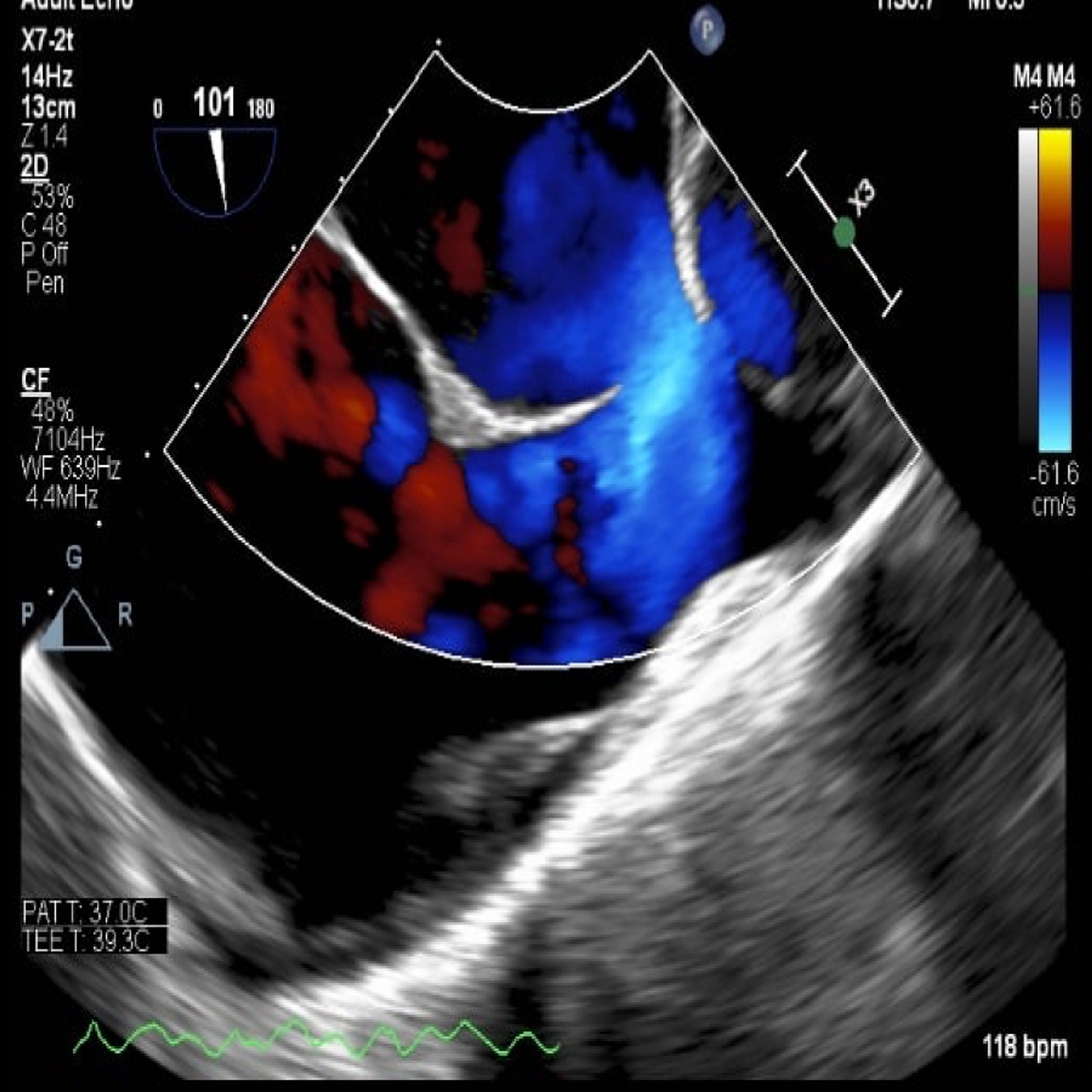 sinus venosus asd