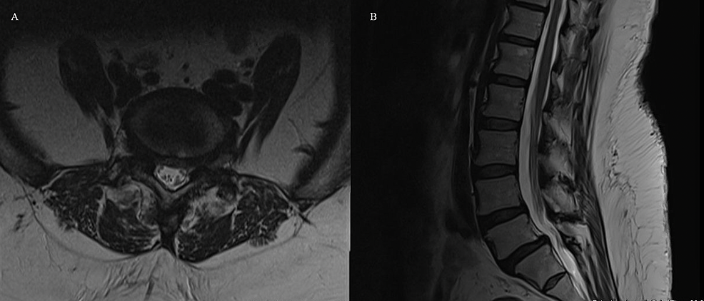 Axial-(A)-and-sagittal-(B)-T2-weighted-MRI-of-the-lumbar-spine-demonstrating-L4/5-and-L5/S1-grade-1-spondylolisthesis-with-foraminal-stenosis-and-minimal-central-stenosis